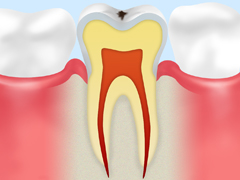 C0　初期のむし歯